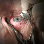 PARKER KRAFF LASIK